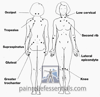 Tender points for Fibromyalgia symptoms