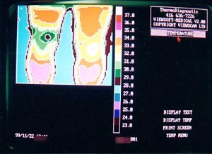 Thermotex leg thermography 1