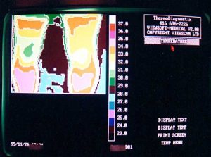 Thermotex leg thermography 3