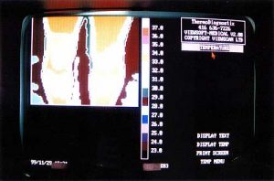 Thermotex leg thermography 2