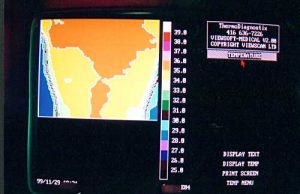 Thermotex upper back thermography 3